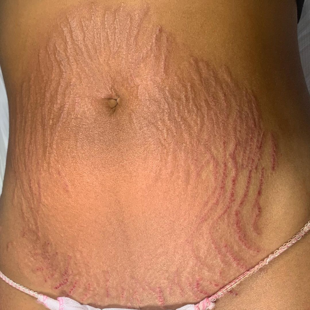 how stretch marks are formed