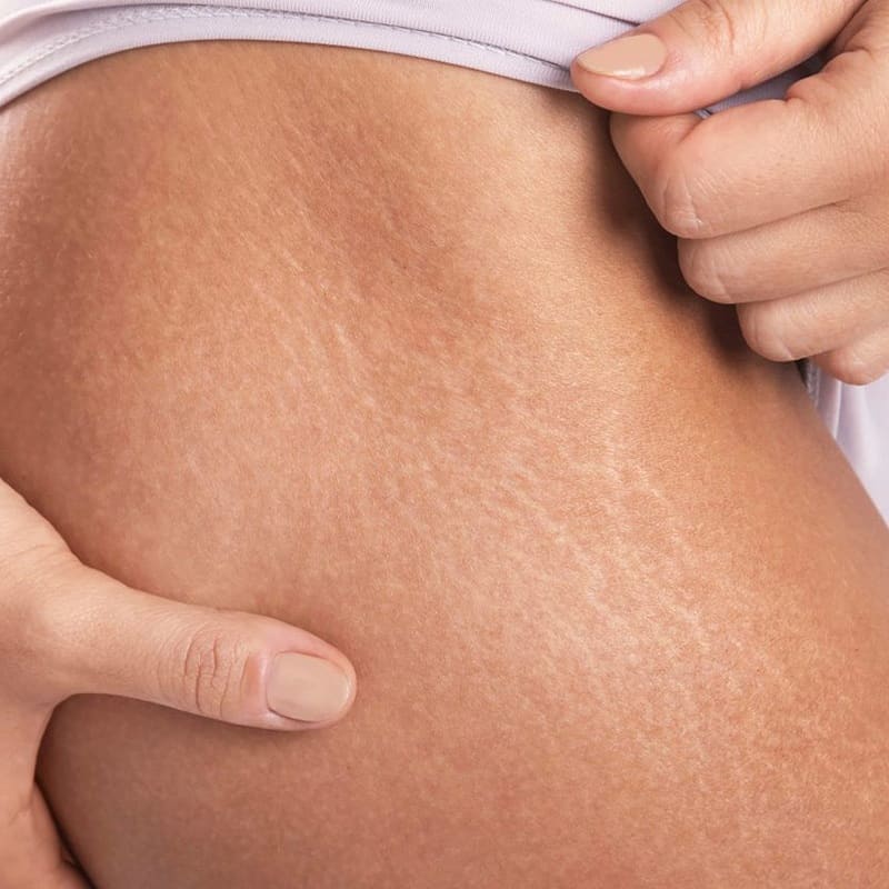 how stretch marks are formed