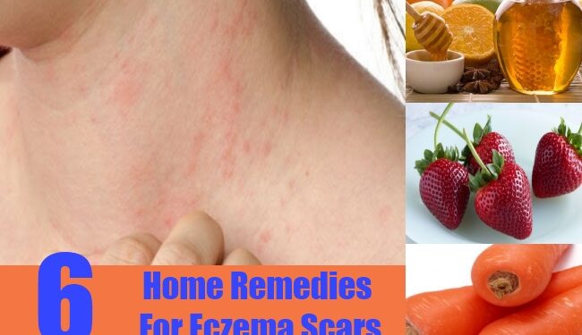 Can Eczema Cause Permanent Scarring?