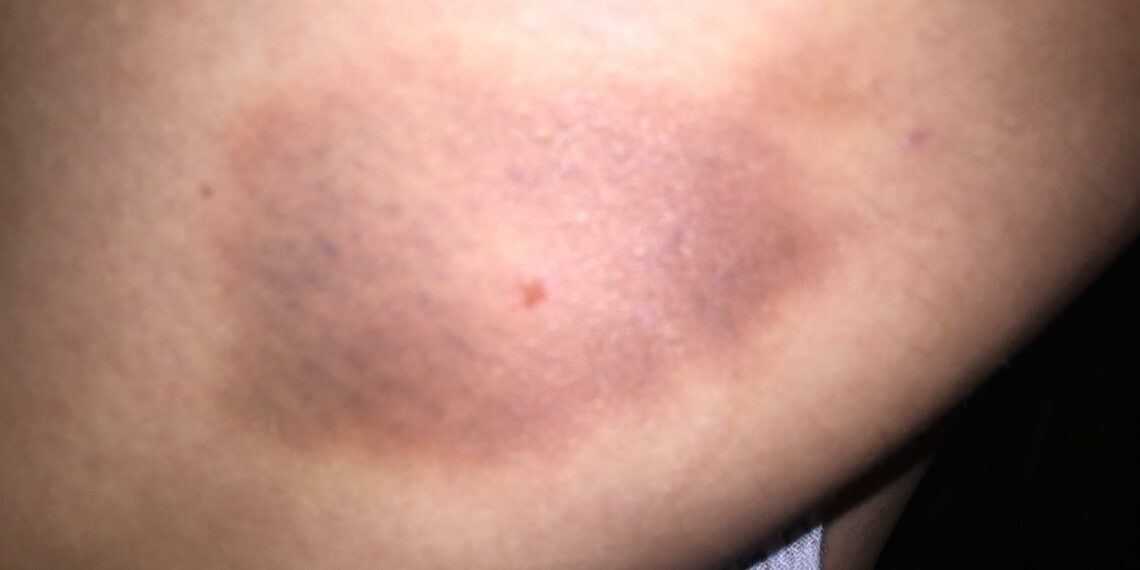 What Causes Purple Bruising On The Skin