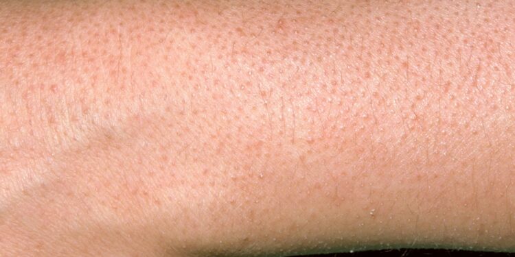 does-diet-affect-keratosis-pilaris