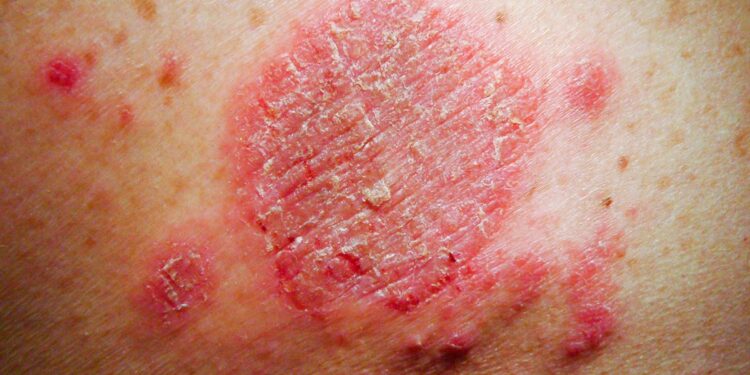 how-do-you-lighten-eczema-scars