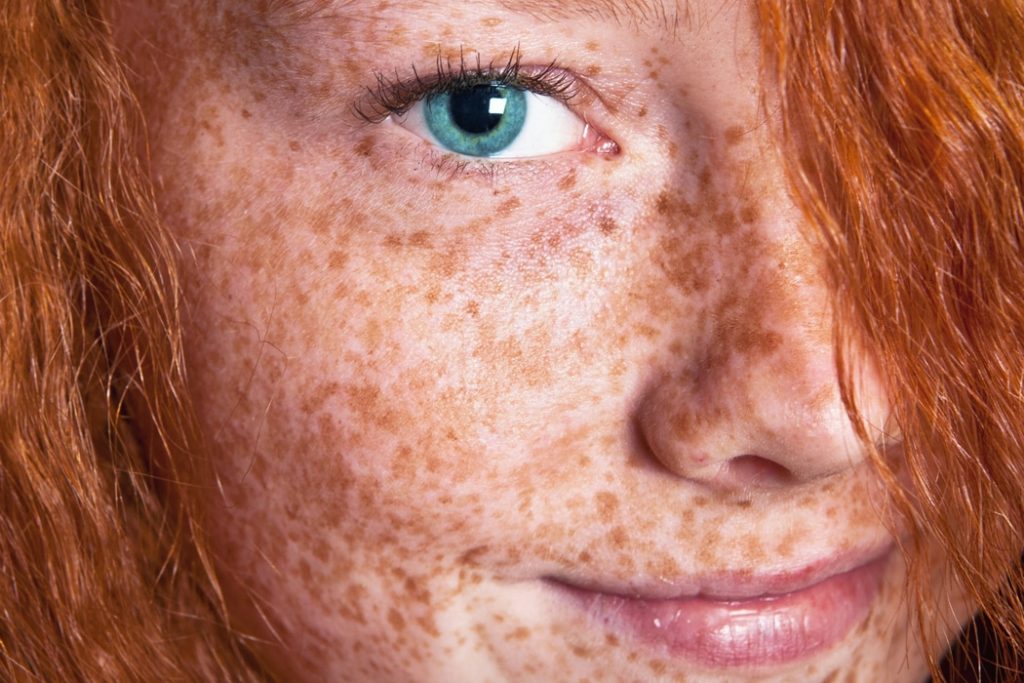 can you fade freckles        <h3 class=