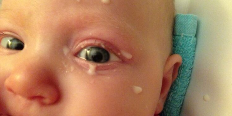 how-long-does-sticky-eye-last-in-newborns