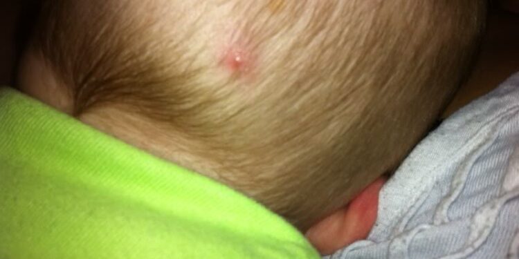 how-to-treat-cradle-cap