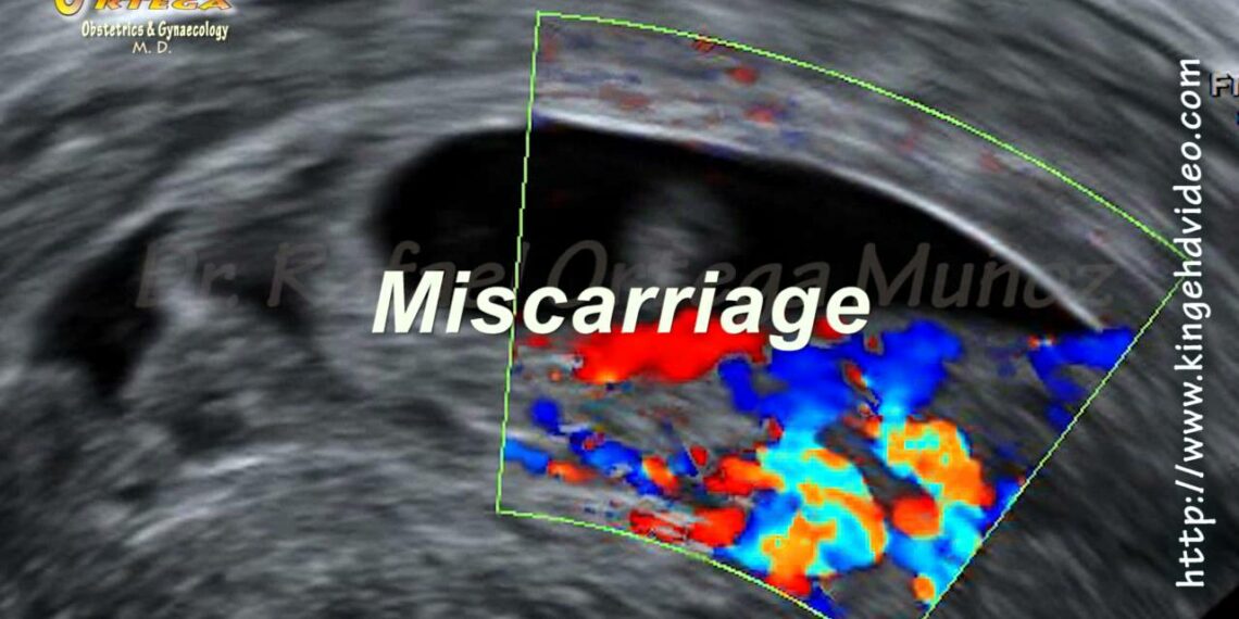 What Is A Miscarriage Baby Called?