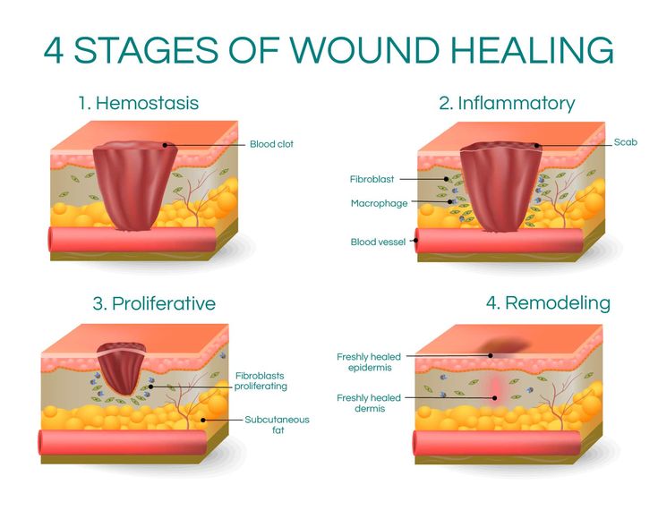 what-is-poor-wound-healing