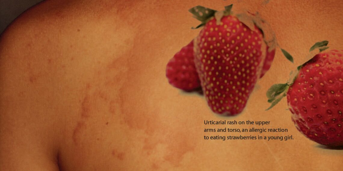 why-am-i-suddenly-allergic-to-strawberries